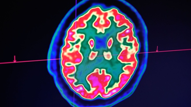 A picture of a human brain taken by a positron emission tomography scanner, also called PET scan, is seen on a screen on January 9, 2019, at the Regional and University Hospital Center of Brest (CRHU - Centre Hospitalier Régional et Universitaire de Brest), western France.  Photographer: Fred Tanneau/AFP/Getty Images